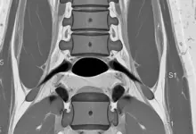 Discopatia degenerativa L5 S1 com protusão discal