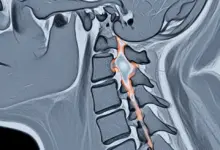 Mielopatia cervical