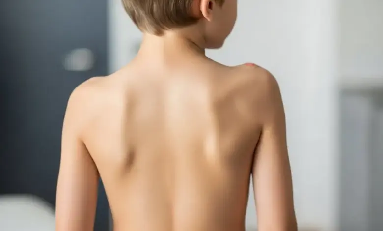 Escoliose congênita