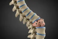 Escoliose degenerativa