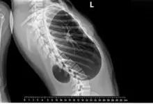 Hemivértebra congênita