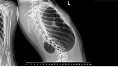 Hemivértebra congênita