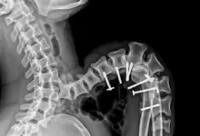 Cifose pós-traumática