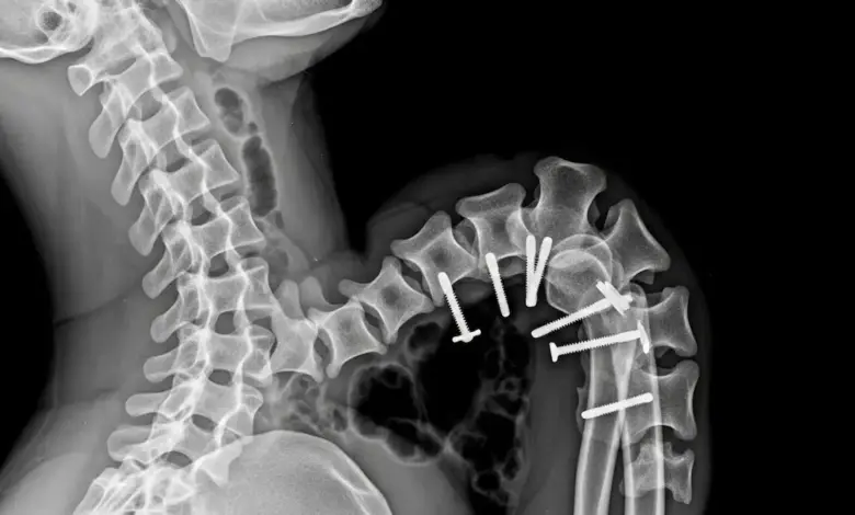 Cifose pós-traumática