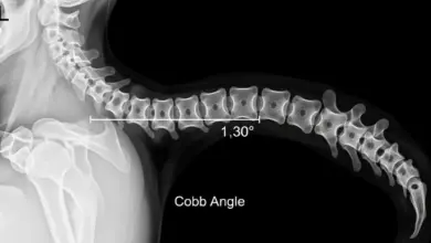 Como saber se tenho cifose