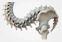 Escoliose pode matar