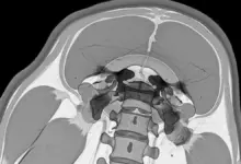 Espondilodiscite piogênica