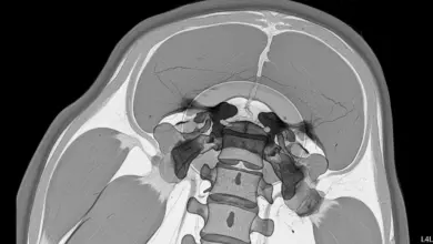 Espondilodiscite piogênica