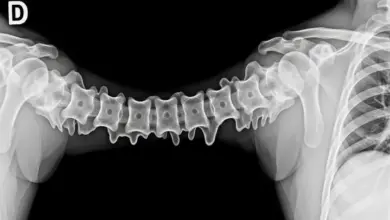 Hiperostose esquelética idiopática difusa