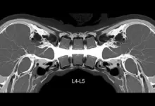 Tratamento para estenose lombar