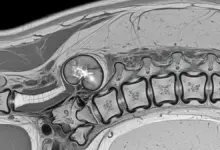 Tumor na coluna é grave