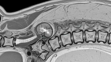 Tumor na coluna é grave