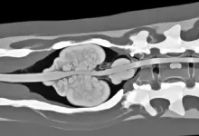 Tumor na coluna tem cura