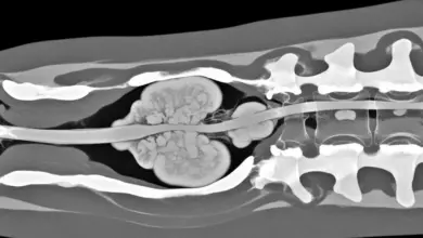 Tumor na coluna tem cura